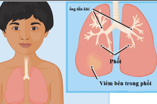 3 benh duong ho hap o tre em de gay tu vong