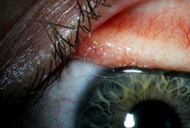 Sơ cứu khi bị dị vật rơi vào mắt, tránh nhiễm trùng mắt cũng như nguy cơ mù lòa - Ảnh 2.