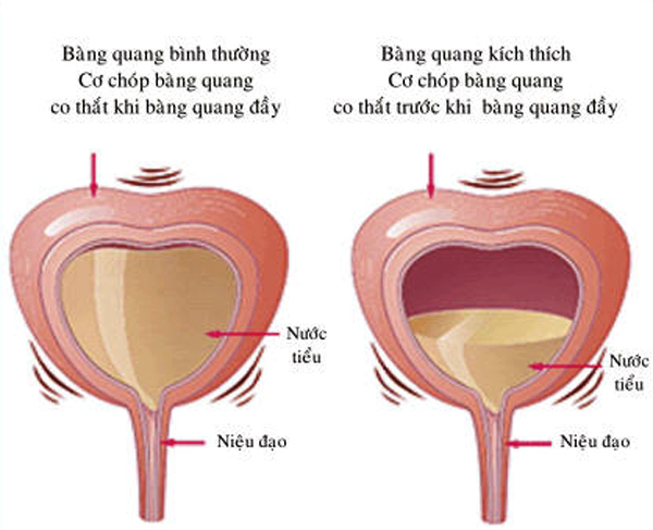 Nguyen nhan dan den viem bang quang cap o phu nu