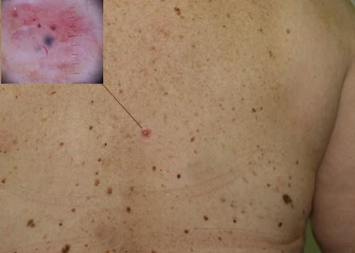 Coi trừng bị ung thư da khi xuất hiện các vệt đen.
