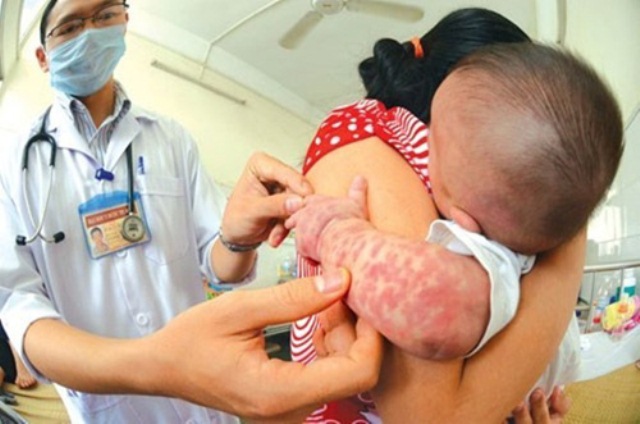 Hình ảnh Hà Nội ghi nhận hơn 200 ca mắc bệnh sởi, nguy cơ bùng phát dịch số 2