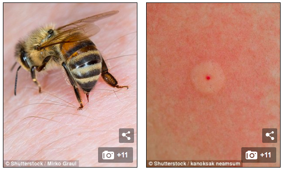 Ong và ong bắp cày có ngòi tiêm nọc độc vào da (trái) và để lại một vết thương màu đỏ có thể gây đỏ và phát ban trên da xung quanh (phải)