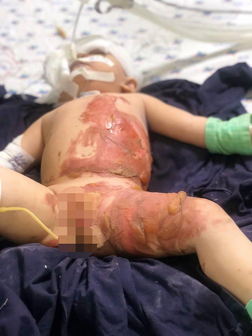 Bé gái 20 tháng tuổi bị lột tróc da do bỏng nước sôi - Ảnh 1.