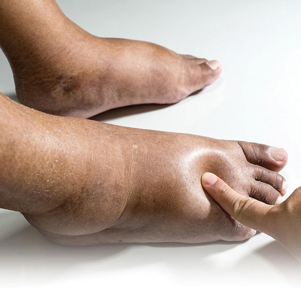 Thận có khỏe hay không, cứ nhìn vào 4 đặc điểm ở bàn chân là rõ ngay vấn đề - Ảnh 1.