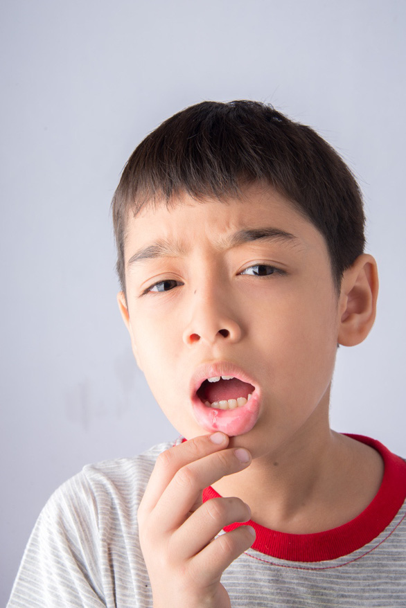 Nhận biết và xử trí bệnh lý niêm mạc miệng thường gặp ở trẻ em - Ảnh 1.