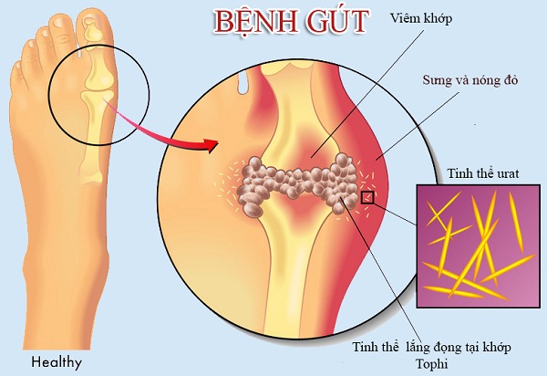 chi so axit uric bao nhieu thi bi gout