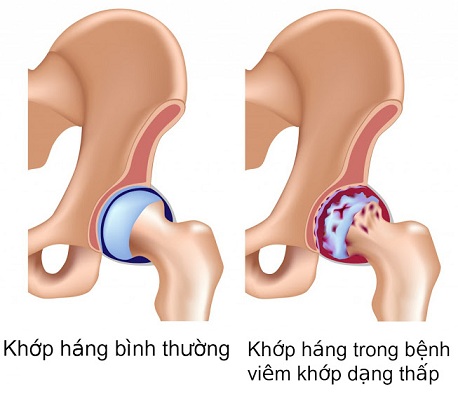 trieu chung viem khop hang