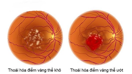 thoai hoa diem vang o mat co nguy hiem khong