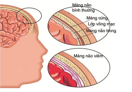 viem mang nao o nguoi lon