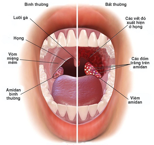 cach chua viem hong khi thoi tiet that thuong