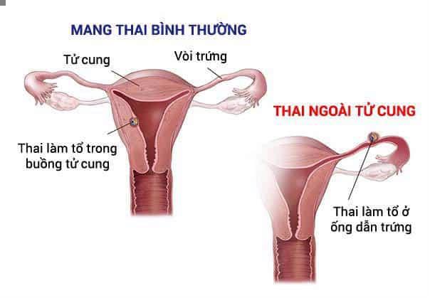 Nguyen nhan chay mau nau khi mang thai ma me bau nhat dinh phai biet
