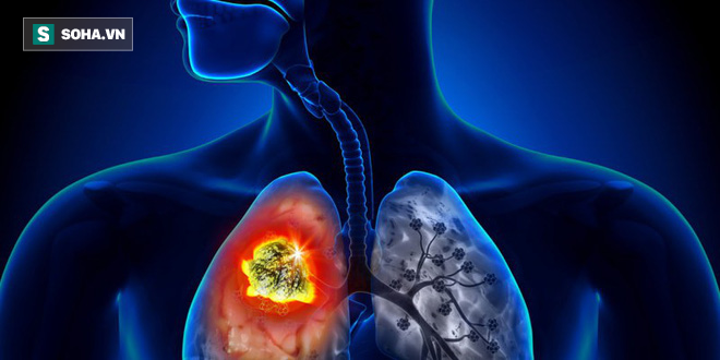 Xu hướng người trẻ tuổi mắc ung thư phổi đang tăng nhanh: Làm sao để phát hiện sớm nhất? - Ảnh 1.