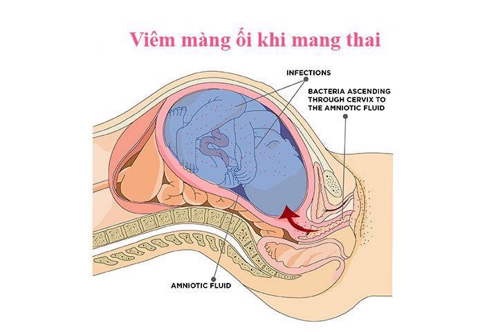 Nguyen nhan viem mang oi va nhung dieu khong tot cho thai nhi, me bau nen biet