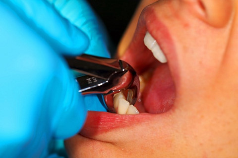 Hình ảnh Bệnh nhân 65 tuổi ở Bắc Ninh nguy kịch sau khi nhổ răng số 8 số 1
