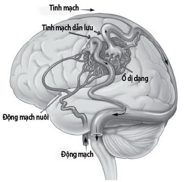 Nhận diện những cơn đau đầu nguy hiểm - Ảnh 1.