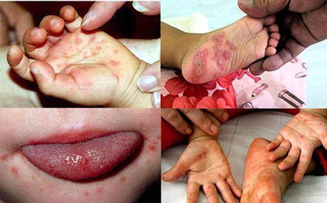Hình ảnh Hà Nội: Đã có 10 trẻ mắc tay chân miệng biến chứng nặng, dương tính với EV71 số 1