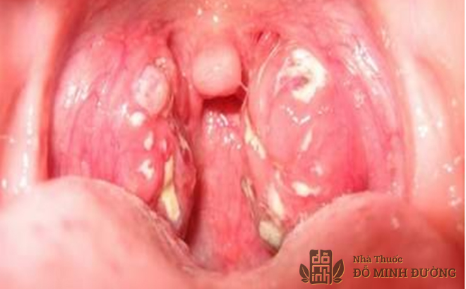 Viêm họng hạt: Nguyên nhân, dấu hiệu và cách chữa bệnh dứt điểm, không tái phát - Ảnh 1.