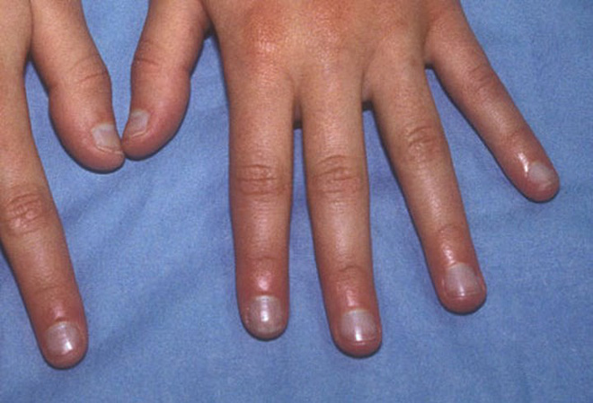 Móng tay tiết lộ những dấu hiệu về sức khỏe của bạn - Ảnh 4.