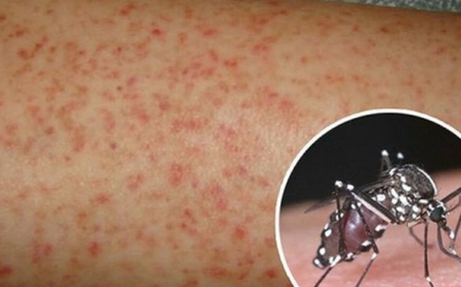 7 biến chứng nguy hiểm của sốt xuất huyết