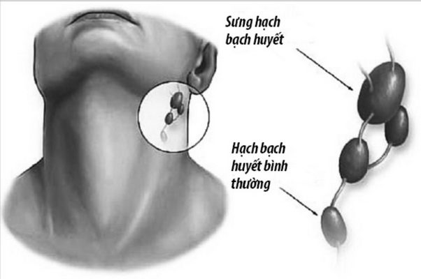 Bệnh lao hạch có lây không? - Ảnh 1.