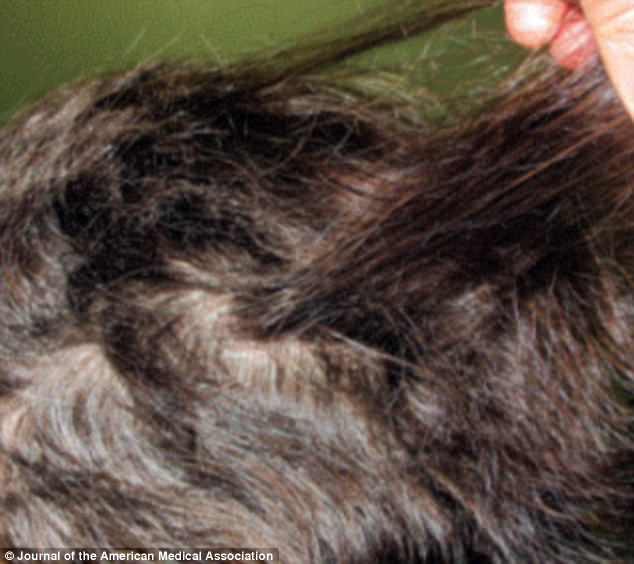 
Hình ảnh mái tóc của một nạn nhân chỉ mới mọc được 6cm sau 6 tháng xảy ra sự việc.
