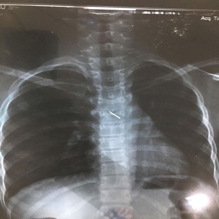 Hình ảnh đinh ghim trong lồng ngực bệnh nhân qua chụp X- quang.