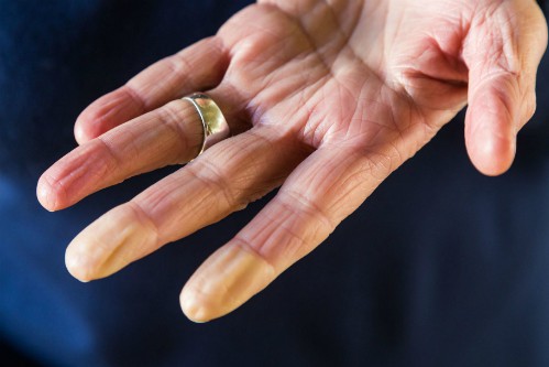 Ngón tay đổi màu do hội chứng Raynaud. Ảnh: Prevention.