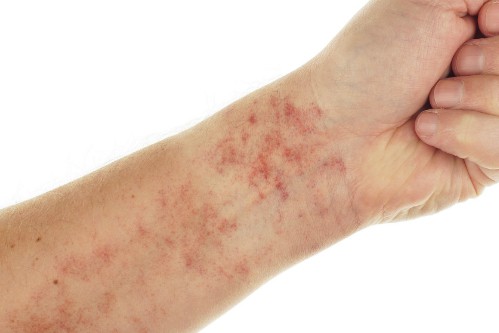 Bệnh nhân lupus nổi các chấm đỏ trên da do mạch máu bị rò rỉ. Ảnh: Prevention.