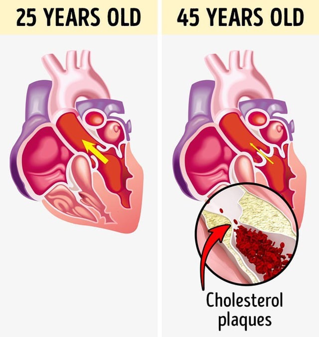 
Hình ảnh thể hiện sức khỏe tim mạch ở tuổi 25 và tuổi 45, các mạch máu bị tắc nghẽn.
