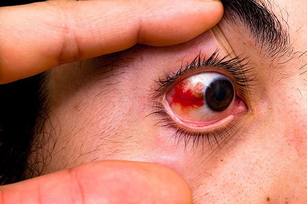 Sơ cứu đúng cách khi bị bọ xít “đái” vào mắt, tránh biến chứng nguy cơ mù lòa - Ảnh 4.