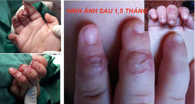 
Hai đốt ngón tay của bé Trương Khánh Toàn (21 tháng tuổi, ở huyện Thống Nhất, Đồng Nai) đã được bác sĩ tái tạo lại (ảnh bệnh viện cung cấp).
