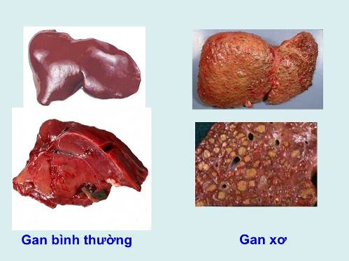 4 nguyen tac phong ngua xo gan hieu qua