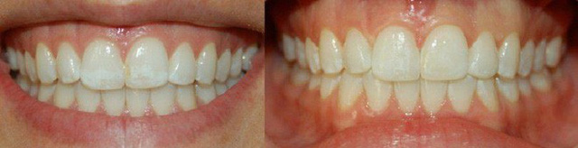 
Các chuyên gia nha khoa khẳng định rằng, răng màu vàng nhạt mới là mẫu răng khỏe nhất. (Ảnh minh họa).
