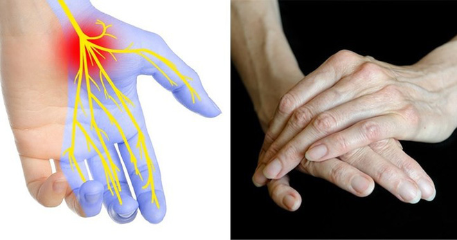 Dấu hiệu bàn tay cho thấy các vấn đề về sức khỏe của bạn - Ảnh 3.