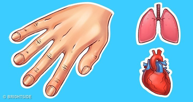 Dấu hiệu bàn tay cho thấy các vấn đề về sức khỏe của bạn - Ảnh 7.