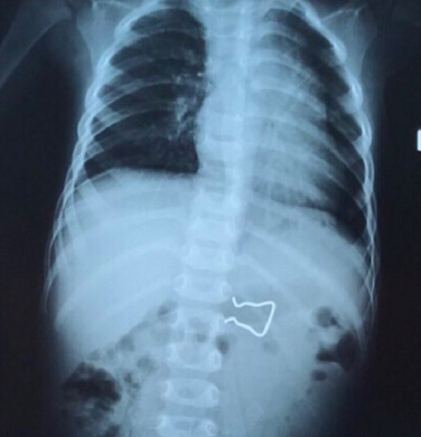 Chiếc móc sắt được phát hiện qua hình ảnh X-quang 
