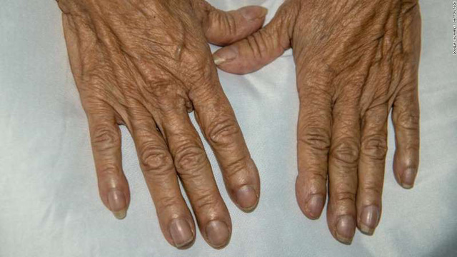 Ngón tay dùi trống trên một bệnh nhân nữ