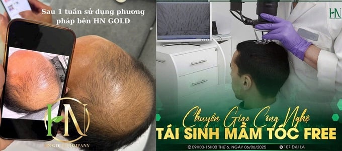 Công nghệ tái sinh mầm tóc thực chất chỉ là sử dụng sản phẩm dầu gội xả thông thường và bôi detox, serum không nhãn mác?