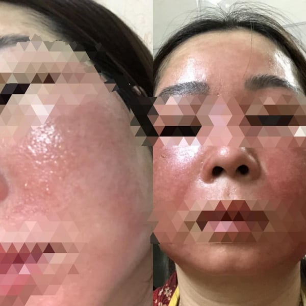 Da mặt khách hàng bị hỏng sau khi điều trị nám da tại Nhung Spa