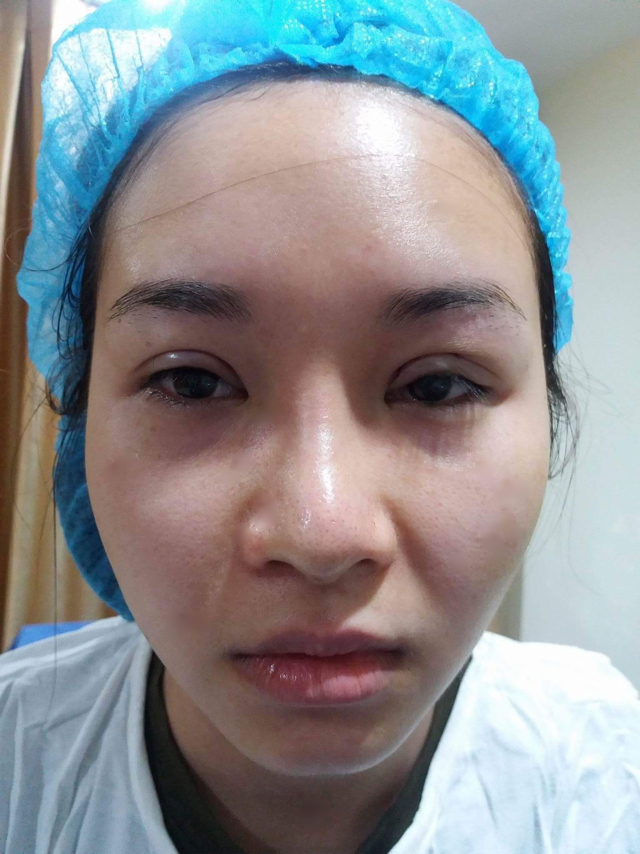 Năm 2017, chị Đặng Thị Phương Nhung sau một tháng phẫu thuật, mũi chị bị lòi sụn trong trụ mũi và đầu mũi lệch về bên trái.