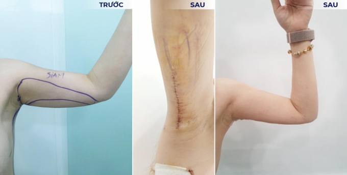 Hình ảnh trước và sau khi chị H sử dụng dịch vụ căng da tay tại Siam Thailand