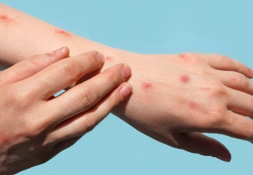 Monkeypox has symptoms similar to smallpox but differs in its systemic skin lesions and enlarged lymph nodes. Photo courtesy of Shutterstock.