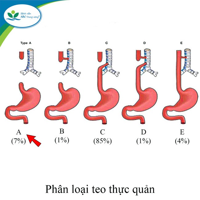 Dị tật teo thực quản typ A là dị tật phức tạp, hiếm gặp, việc phẫu thuật và hậu phẫu khó khăn. 