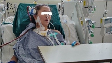 Lạm dụng corticoid tự điều trị cúm, bệnh nhân phải chạy ECMO 37 ngày do viêm phổi bội nhiễm