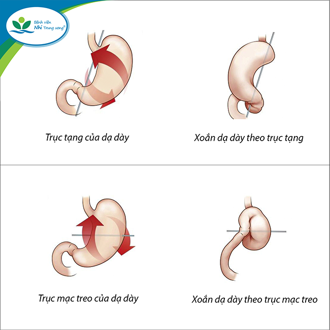 Hình ảnh xoắn dạ dày theo trục tạng và trục mạc treo. Ảnh: BVCC