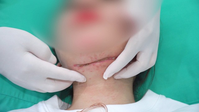 Tiêm tan mỡ và những lưu ý không phải ai cũng biết