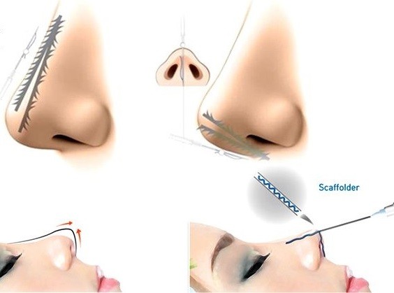 nâng mũi bằng chỉ tuy có mức giá thẩm mỹ thấp nhưng lại có nguy cơ để lại nhiều biến chứng về lâu dài