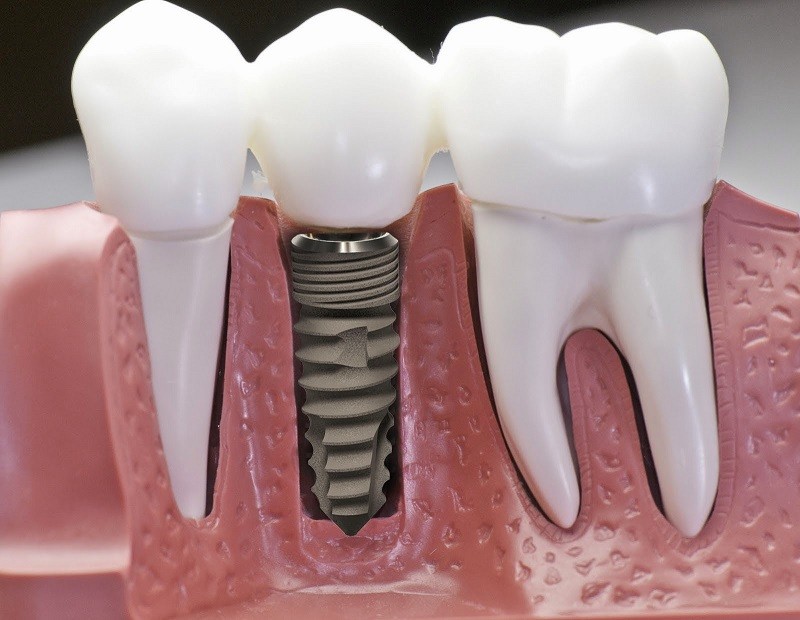 Cấy ghép Implant thực chất là tạo nên một chiếc răng giả thay thế vào vị trí của răng đã mất đi