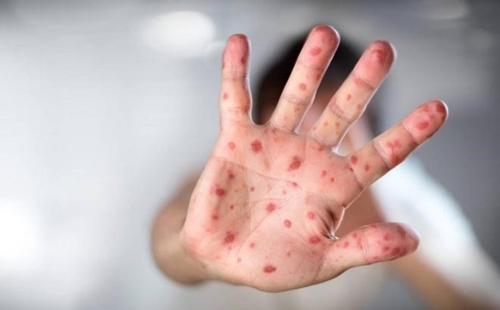 Bệnh chân tay miệng có thể lây qua