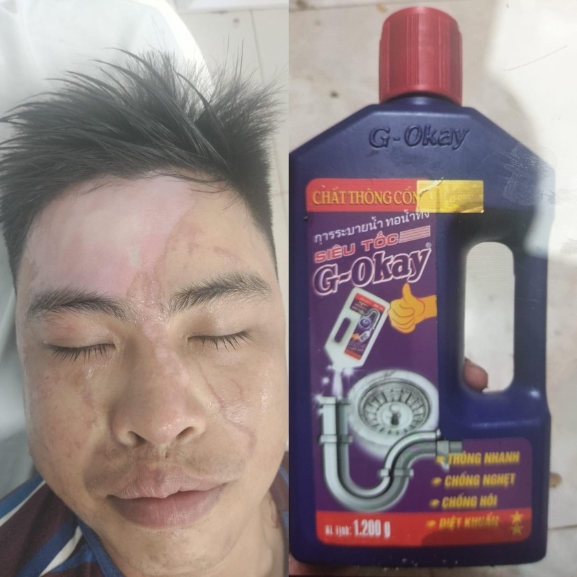 Anh Thái bị bỏng rộng vùng mặt do sử dụng chai thông cống siêu tốc. Ảnh: Báo Gia Lai